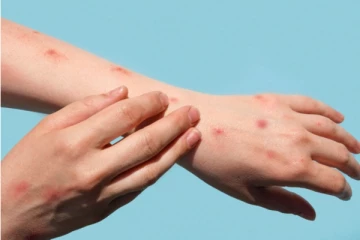 தீவிரமாக பரவும் குரங்கு அம்மை நோய் - பாதிப்போர் எண்ணிக்கை கிடு கிடு உயர்வு..!