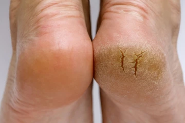 வெடிப்புள்ள குதிகால் கூட ஒரே நாளில் மென்மையாக மாறும், இதை செய்யுங்கள்