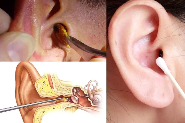 காதில் பட்ஸ் வைத்து சுத்தம் செய்பவரா நீங்கள்? இனி அந்த தவறை செய்திடாதீங்க | Ear Infection Symptoms In Tamil