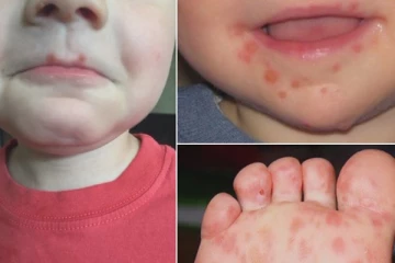 குழந்தைகளை அச்சுறுத்தி வரும் கை பாத வாய் நோய்! அறிகுறிகள் என்ன?