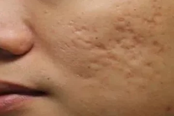 7 நாட்களில் உங்கள் முகத்தில் உள்ள அசிங்கமாக பள்ளங்களை போக்கனுமா? இதோ சூப்பரான டிப்ஸ்!