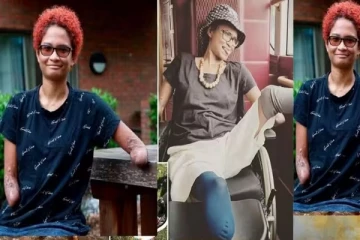 கொசுக்கடியால் கை, கால்களை இழந்த பிரித்தானியாவை சேர்ந்த நடனக் கலைஞர்