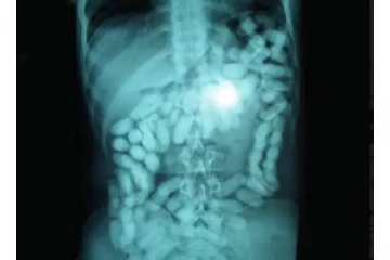 விமான நிலையத்தில் சிக்கிய நபர் - வயிற்றை சோதனை போட்ட போது அதிர்ச்சி அடைந்த அதிகாரிகள்