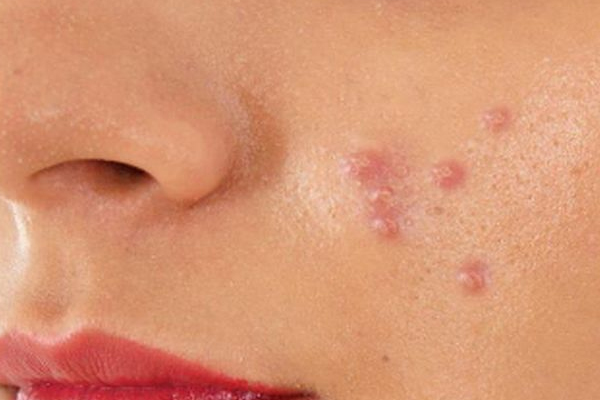 தோல் நோய்கு நிவாரணம் தரும் தக்காளி | Tomato For Skin Disease Relief