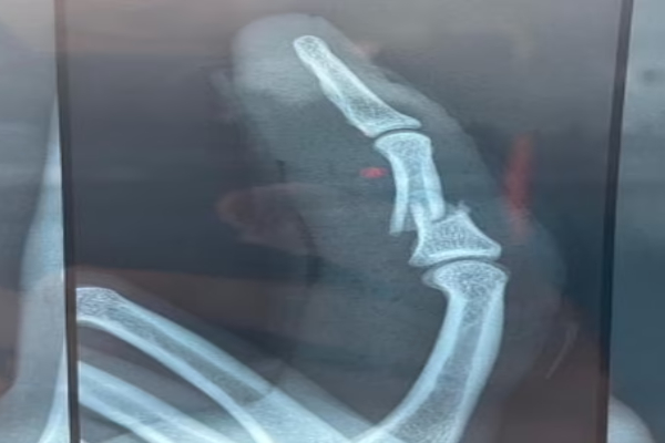 அதிர்ச்சியில் மும்பை அணி - வெளியேறினார் கிரீன் | X Ray Australia Ace Cameron Green Batted Finger