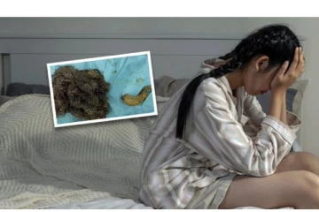 வயிற்று வலியால் அவதிப்பட்ட பெண் - பரிசோதனையில் வயித்துக்குள் 3 கிலோ முடி... - மருத்துவர்கள் ஷாக்...!