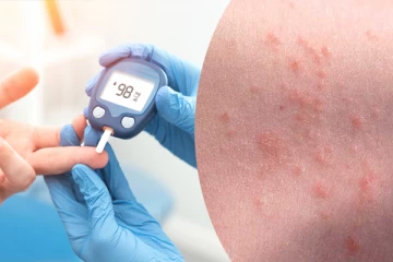 சர்க்கரை நோயாளிகளுக்கு அதிகமாக வரும் வியர்க்குரு பிரச்சனை... இதற்கான தீர்வு இதோ