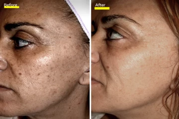 சருமத்தில் அடர்த்தியான கருமையை நீக்க வேண்டுமா?