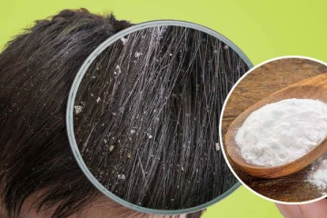 உச்சந்தலையில் உள்ள பொடுகை விரட்ட இந்த ஒரு பொருளே போதும்!