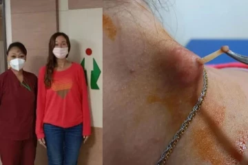 அமேசான் காட்டுக்குள் உயிருடன் கண்ணில் நுழைந்த “மனித பூச்சி”! திடுக்கிட வைக்கும் சம்பவம்