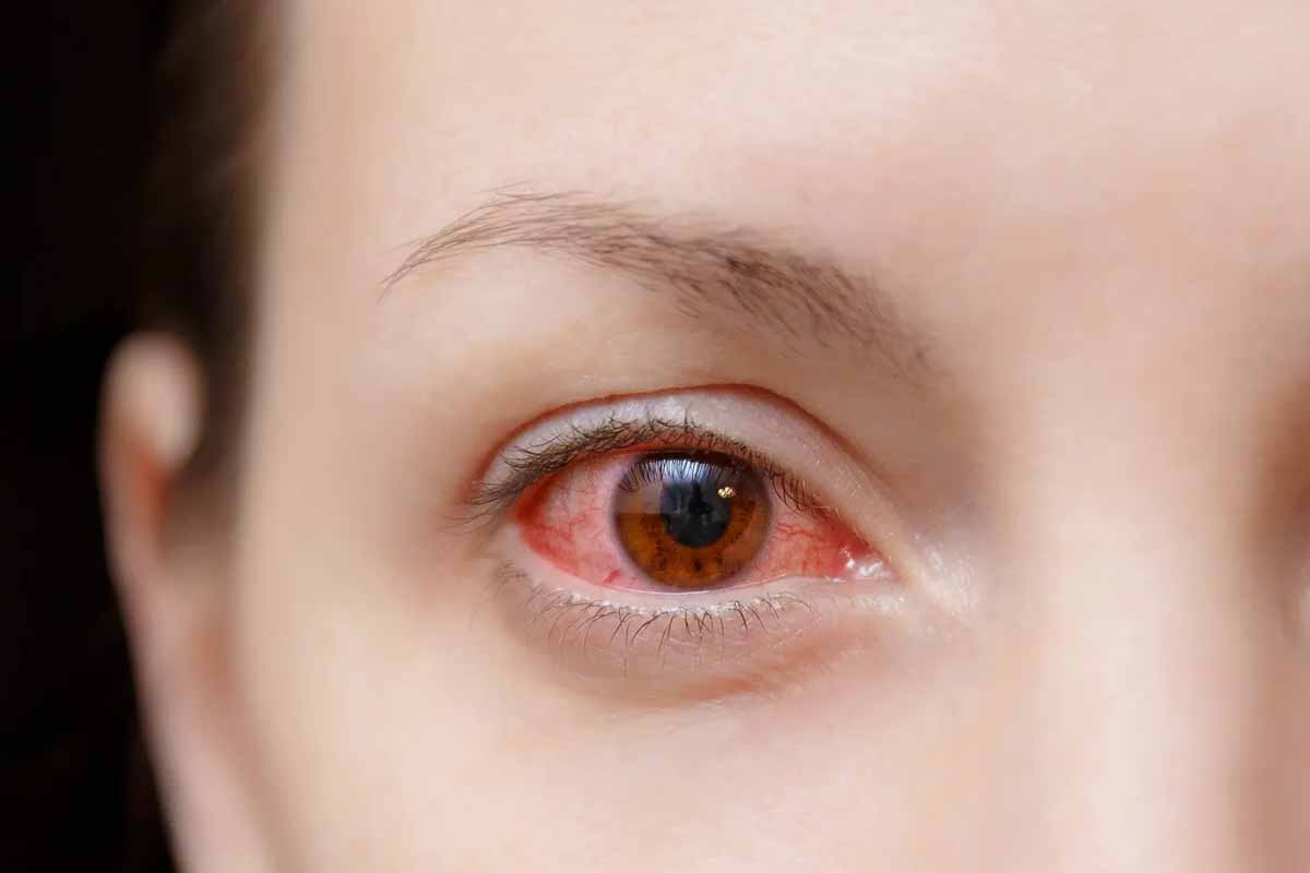 சென்னையில் தீவிரமாக பரவி வரும் மெட்ராஸ் ஐ | Madras Eye Spread In Chennai