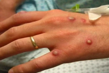 குரங்கு அம்மை நோய்க்கு புதிய பெயர் சூட்ட வேண்டும் என ஆராய்ச்சியாளர்கள் கோரிக்கை