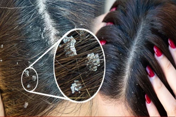 பொடுகுத் தொல்லைக்கு Bye Bye சொல்லலாம்