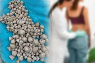 யுவதி ஒருவரின் சிறுநீரகத்தில் 300க்கும் மேற்பட்ட கற்கள்; அதிர்ச்சியில் மருத்துவர்கள்!