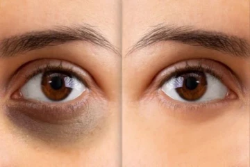 கருவளையம் நிரந்தரமாக நீங்க இந்த ஒரு பொருள் போதும்: எப்படி பயன்படுத்துவது?