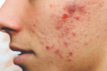 முகப்பரு தொல்லையா? இதனை எளிய முறையில் போக்க இதோ சூப்பரான டிப்ஸ்!