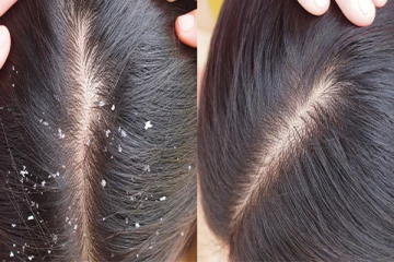 பொடுகு தொல்லையை போக்கும் சூப்பரான 10 டிப்ஸ் இதோ!