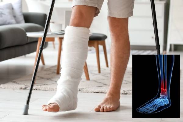 bone fracture