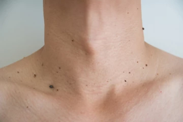 உடலில் அசிங்கமாக இருக்கும் மருக்களை விரட்ட  வேண்டுமா? சில எளிய வழிகள் இதோ