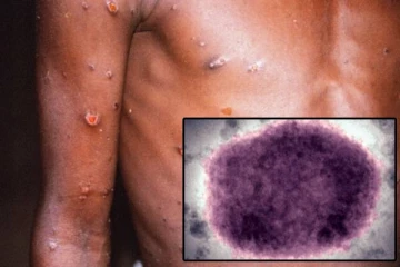 12 நாடுகளுக்கு பரவிய குரங்கம்மை நோய்: உலக சுகாதார அமைப்பு எச்சரிக்கை!