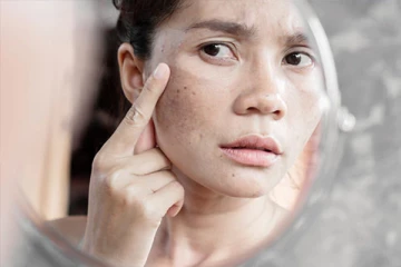 முகத்தில் கரும்புள்ளியா? இவற்றை எளியமுறையில் போக்க இதோ சூப்பரான டிப்ஸ்!