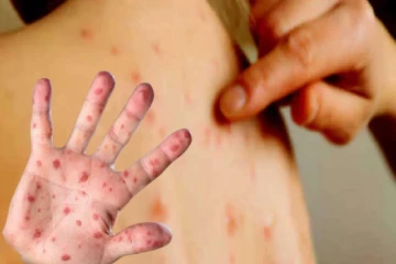 இலங்கையில் மீண்டும் தட்டம்மை நோய் : மரணத்திற்கு வழிவகுக்கும் என எச்சரிக்கை