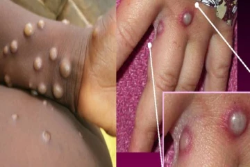 மக்களே உஷார்!! ஓரினச்சேர்க்கையாளர்களிடம் அதிகளவில் பரவும் குரங்கு அம்மை - வெளியான அதிர்ச்சி தகவல்!