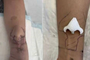 கையில் மூக்கை வளர்த்து முகத்தில் பொருத்திய டாக்டர்ஸ் - சம்பவம் என்ன!