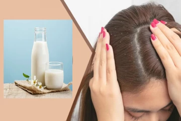 தலையில் உள்ள பொடுகுத் தொல்லைக்கு பால் முழுத்தீர்வு தருமா?