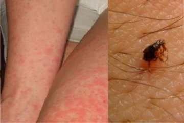 ஸ்கரப் டைஃபஸ்; தமிழகத்தில் 5000 பேர் பாதிப்பு - இதெல்லாம் இருந்தா உடனே டாக்டரை பாருங்க