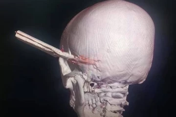 மாணவனின் மண்டை ஓட்டுக்குள் பாய்ந்த உலோகக் கோப்பு! சக மாணவனின் செயலால் நேர்ந்த விபரீதம்