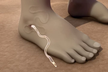 ලොකු කුඩා කාටත් හැදෙන "ක්‍රිමි රෝග" නොසලකා හැරියොත් මොකද වෙන්නේ?