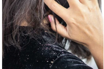 பொடுகு பிரச்சனையில் இருந்து தலைமுடியை பராமரிக்க இந்த இயற்கை பொருள் போதும்! அதிசயம் நடக்கும்