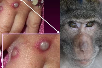 monkeypox! அமெரிக்காவின் 27 மாகாணங்கள்..  நூற்றுக் கணக்கானோர் தீவிர கண்காணிப்பில்