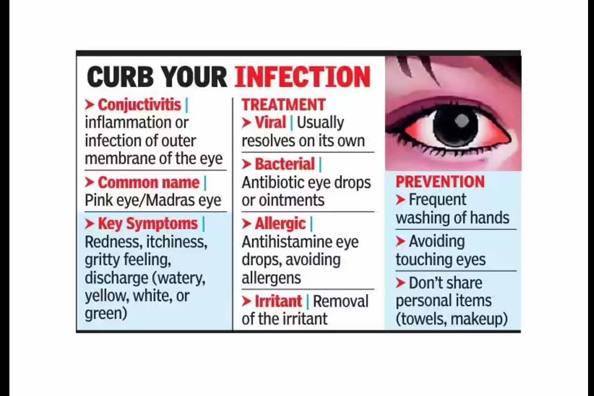 சென்னையில் தீவிரமாக பரவி வரும் மெட்ராஸ் ஐ | Madras Eye Spread In Chennai